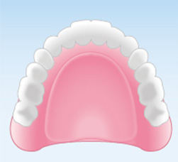 レジン床義歯（保険適用の総入れ歯）