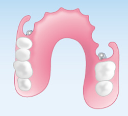 ノンクラスプデンチャー（自由診療の部分入れ歯）