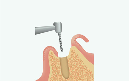 インプラント体の埋入