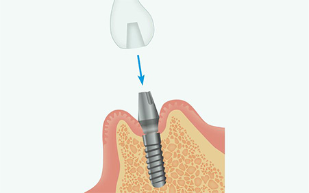 人工歯の型取り、仮歯の装着