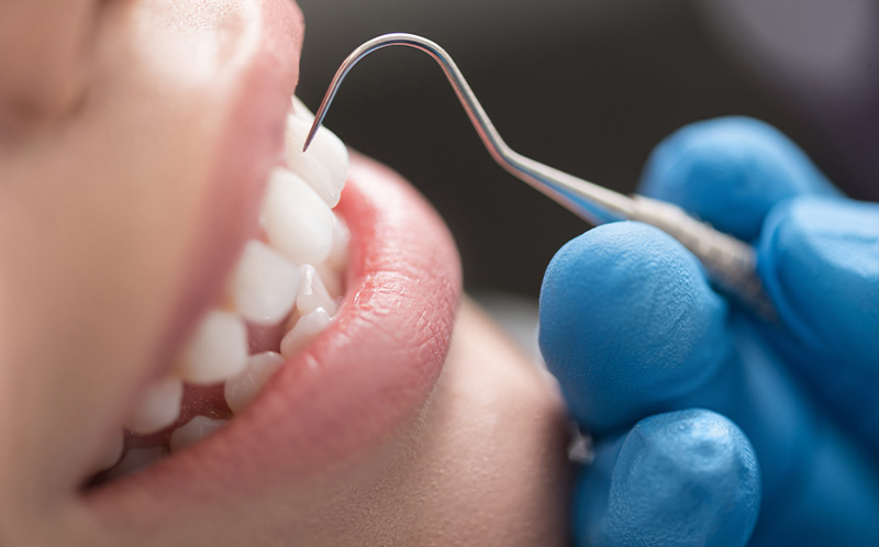 予防・クリーニング